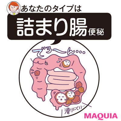 詰まり腸便秘